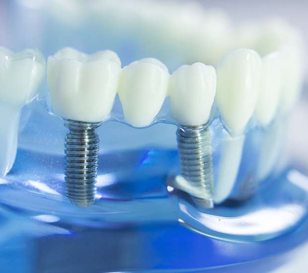 Hallandale Beach Dental Implants