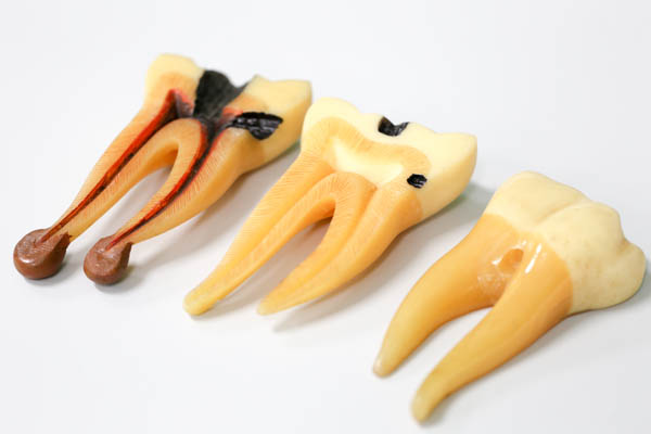 What Will Happen During A Root Canal Procedure?