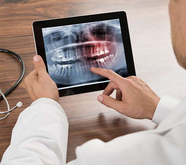 Hallandale Beach Types of Dental Root Fractures